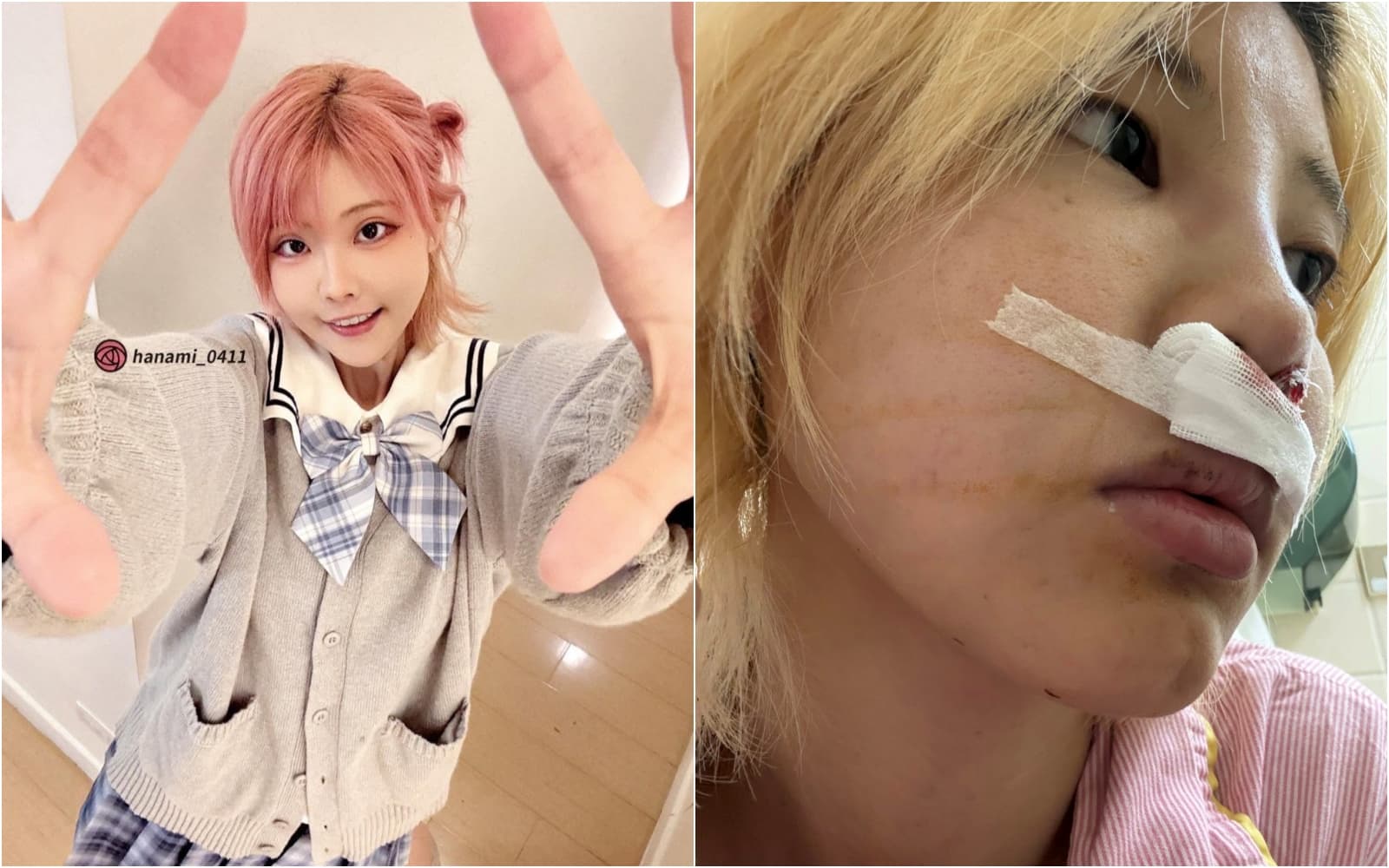 苡琍Hana控訴醫美手術出意外，害她賠了健康還因此無法工作。（翻攝自臉書苡琍 - Hana﻿ ）