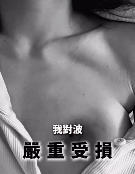 香港「最強小三」鍾睿心胸部被燙傷留下疤痕，還出現傷口感染。（翻攝自IG@5kidsokma_no1fans）