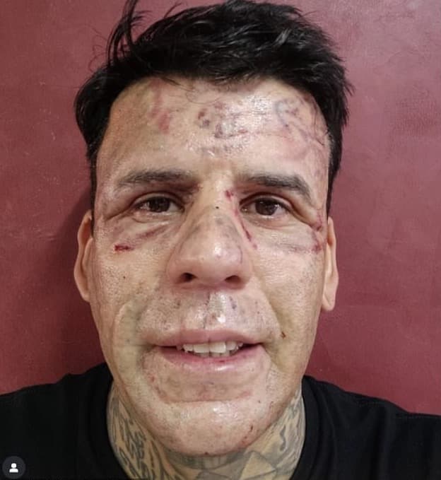 蘇薩接受第5次刺青移除手術後不久的模樣。（翻攝leandrodesouzabless IG）