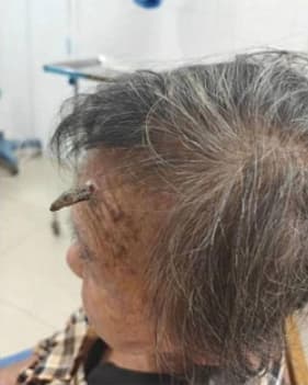這位98歲的奶奶額頭長出「犄角」，因嫌礙事竟自己拿剪刀剪掉，險些大出血送命。（翻攝自環球網資訊）