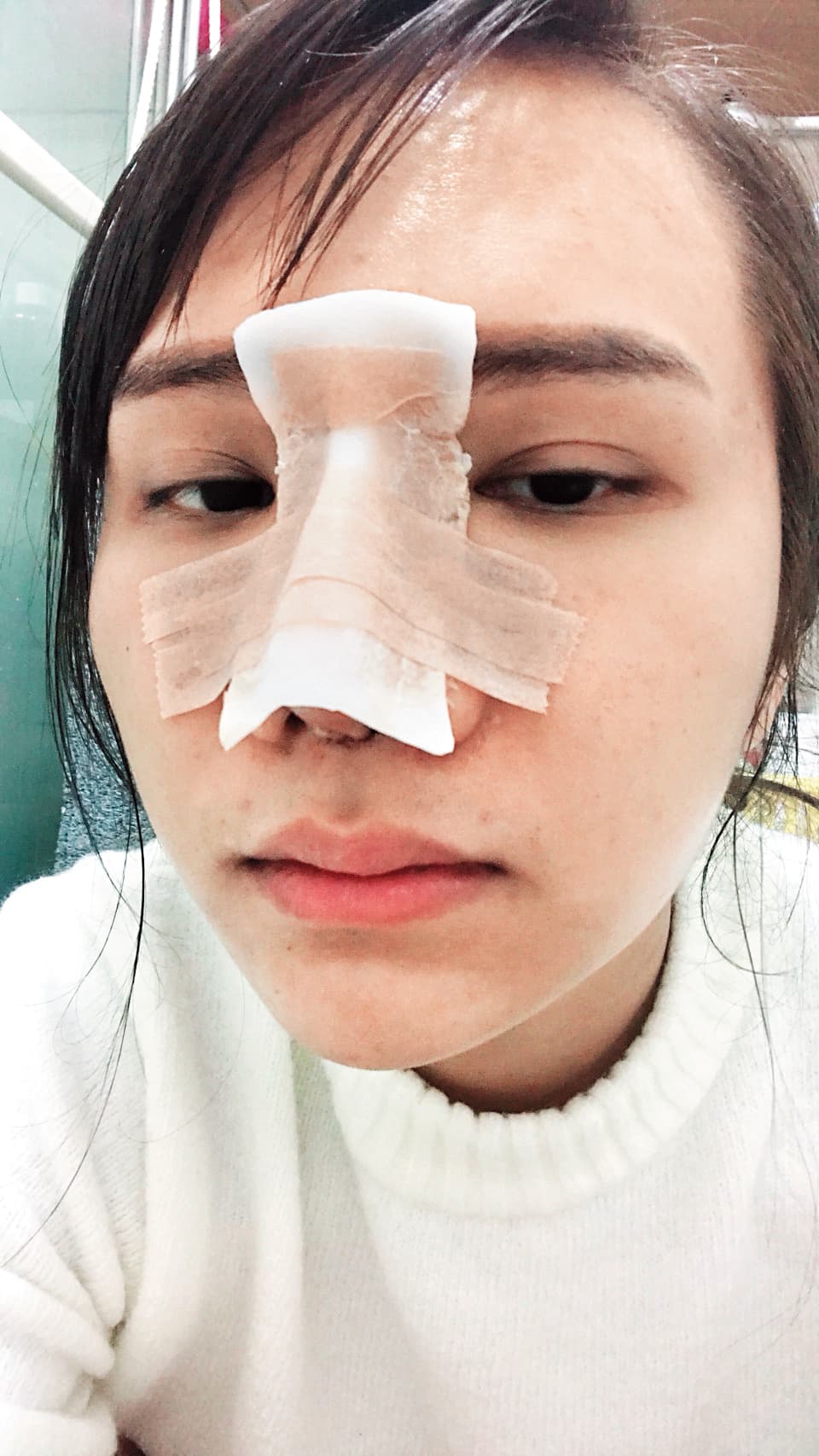 小A辣做完隆鼻手術後恢復中的休養照。（小A辣提供）