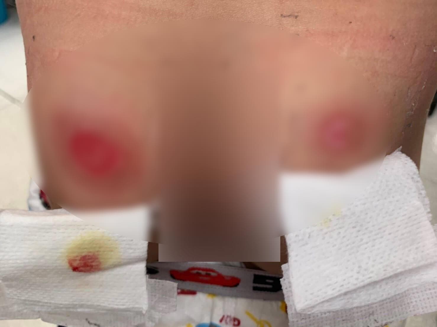 男童臀部左右各有一大一小的傷痕，保母則稱是被稀飯燙傷。（翻攝畫面）