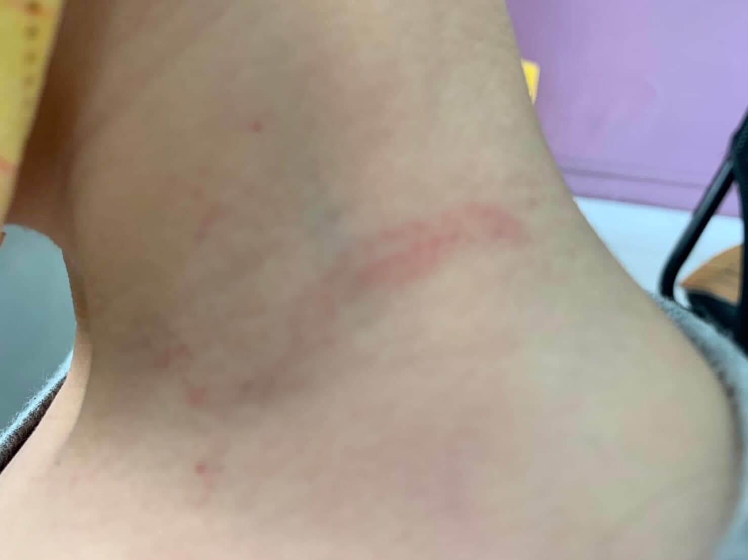 孩子頸部也有抓傷，更稱自己曾被保母丈夫打頭。（翻攝畫面）