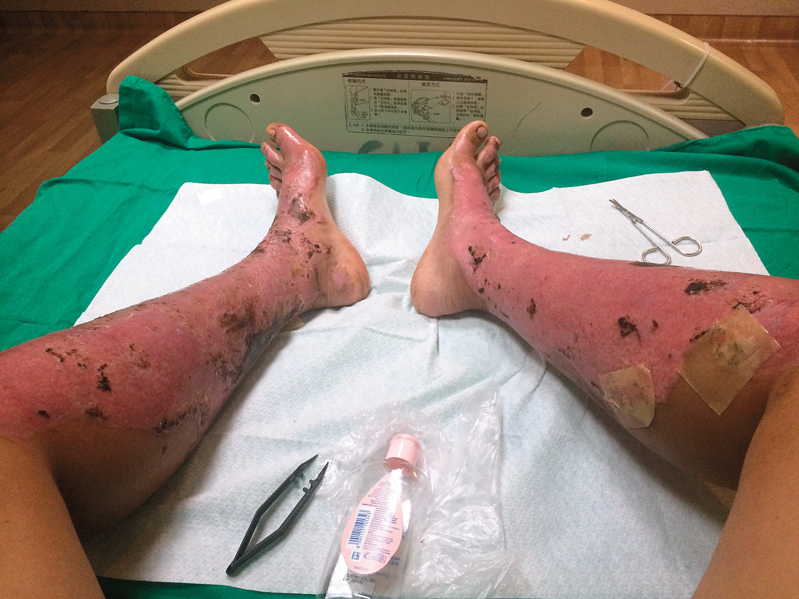八仙塵爆時，手部1、2度灼傷，不算嚴重，但腿部是深2、3度灼傷，後續復健過程中，幾度痛得黃逸柔大哭大叫。（黃逸柔提供）