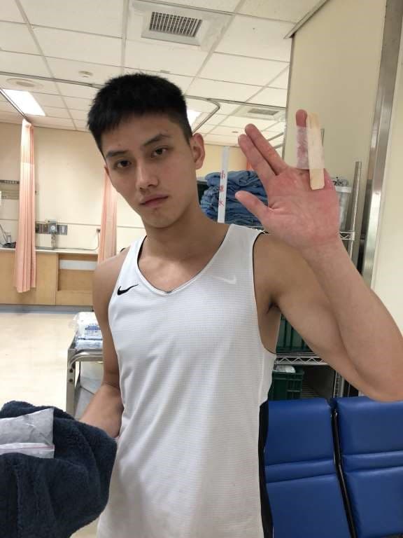 范少勳拍片時左手小拇指因碰撞脫臼變形。（范少勳提供）