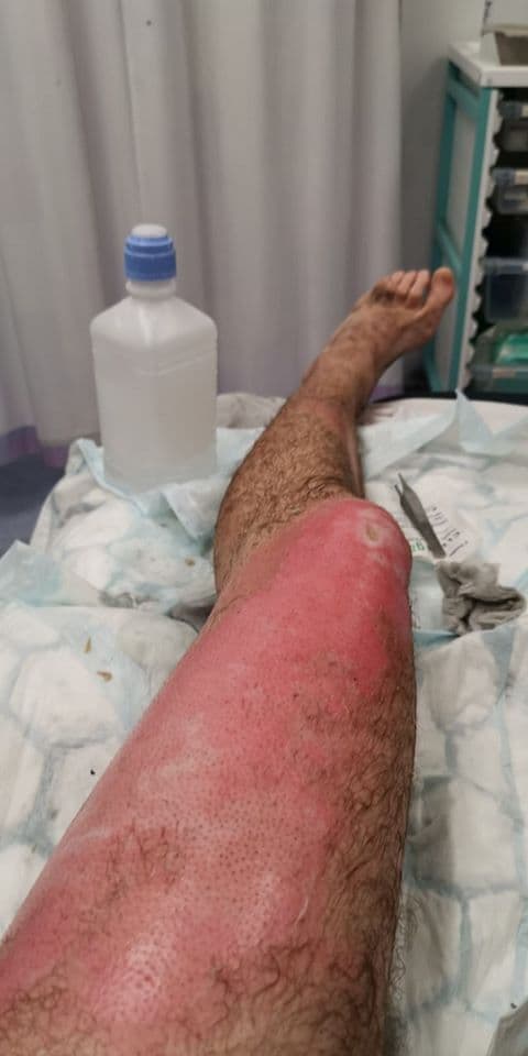男子口袋裡的電子菸爆炸，導致左大腿三度灼傷，大腿燒到焦黑最後皮都不見了。（翻攝London Fire Brigade臉書）