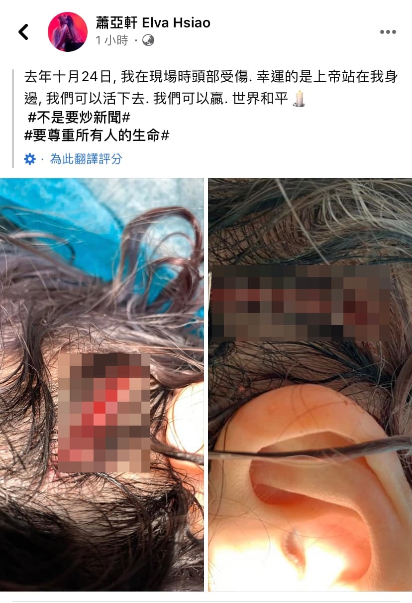 蕭亞軒突然曬出受傷照片。（翻攝自蕭亞軒臉書）