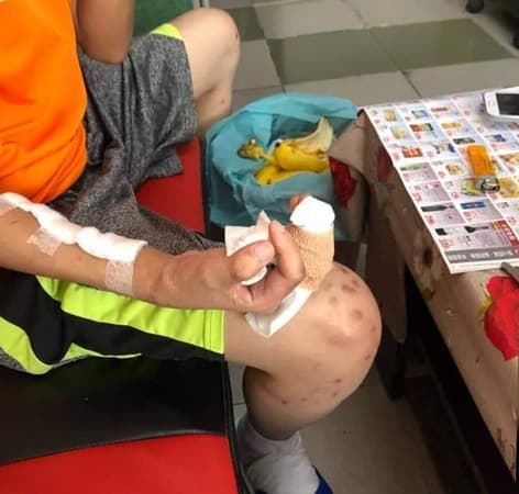 少年渾身是傷，右手也無法倖免，現已失去知覺。（翻攝彰化踢爆網）