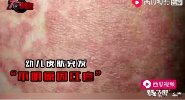 兒童喝下該奶粉，不僅體重變輕、頭骨發育畸形，身體還會出現大面積濕疹。（翻攝自網路）