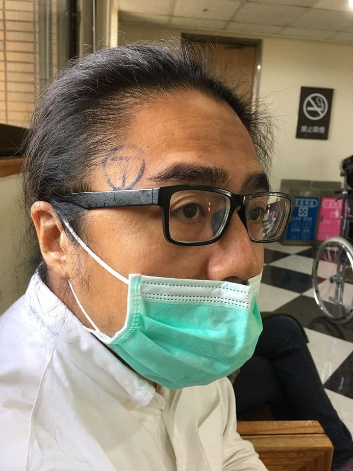 開刀前，周易正的頭部右側被劃上標記，我問他為什麼？他說：「沒有的話，醫生可能會開錯邊。」（周易正提供）