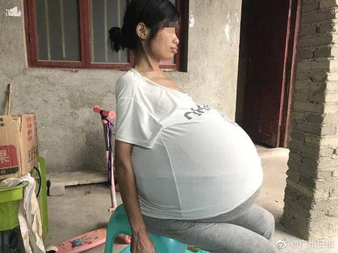中國貴州的黃國嫻肚子在2年內脹大，這樣的大小讓她只能「坐著睡」。（翻攝光明網）