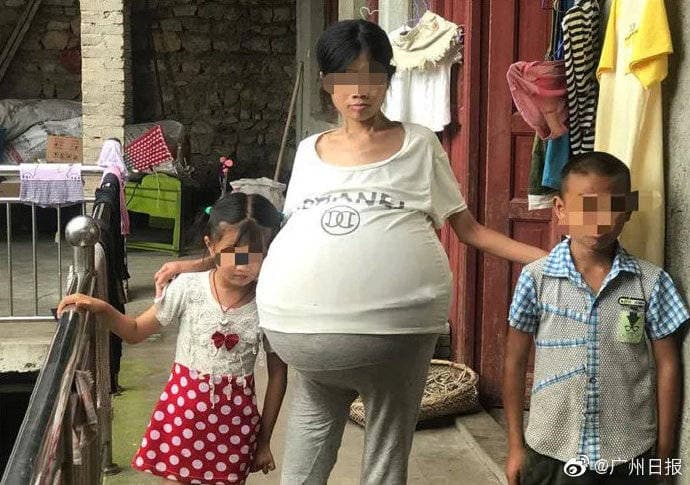 育有兒女的婦人生活相當困苦，醫療費用對她來說相當沉重。（翻攝光明網）