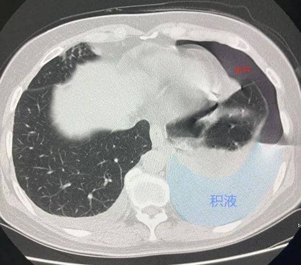 生吃螃蟹半年後，大媽胸腔內滿滿都是氣泡和積水。（取自浙江之聲）