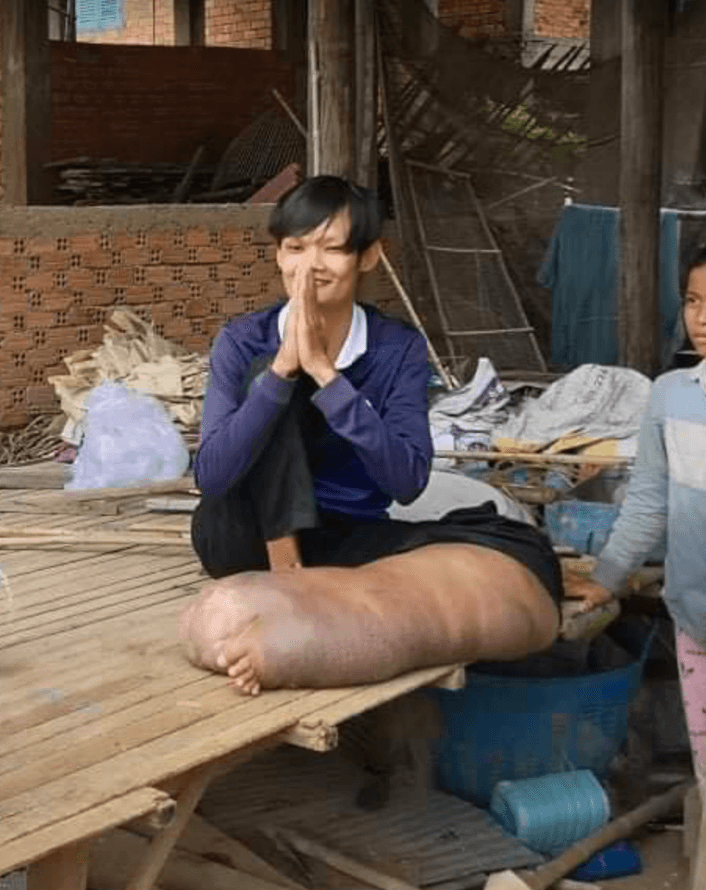 邦特的腳腫脹成一般人5倍大小，造成生活嚴重不便。（圖源：ទ្រី ដាណា Dana Try臉書）