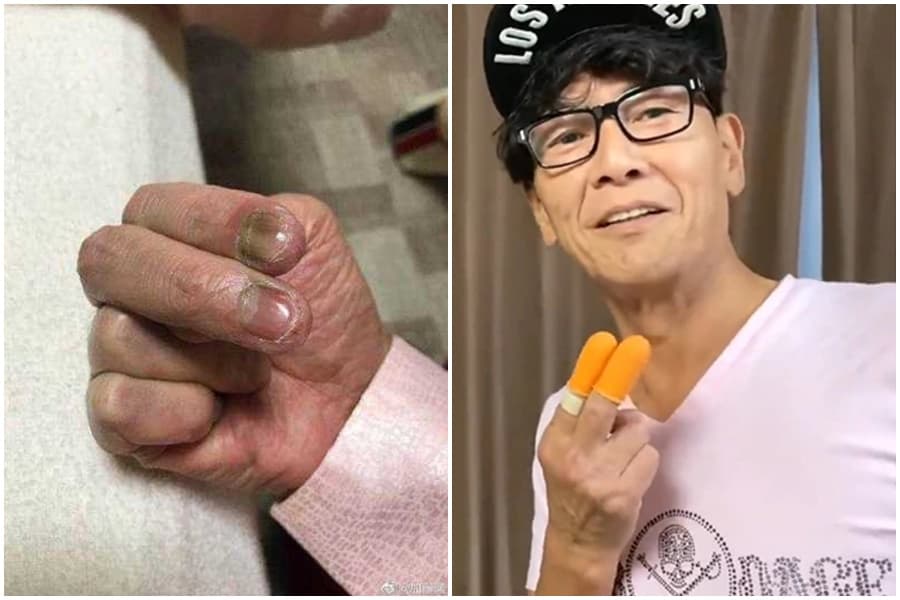 加藤鷹食指、中指竟出現潰爛，指甲甚至還呈灰色。（翻攝自YouTube/加藤鷹推特）