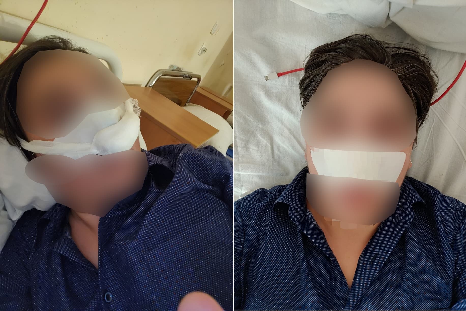 男子幸運接回斷鼻。（翻攝自《fontanka.ru》）