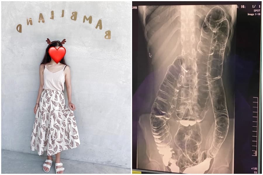 女網友在Dcard透露從小受便祕所苦，照了X光才驚覺大腸竟已擠壓到接近胸腔位置。（翻攝自Dcard、當事人授權）
