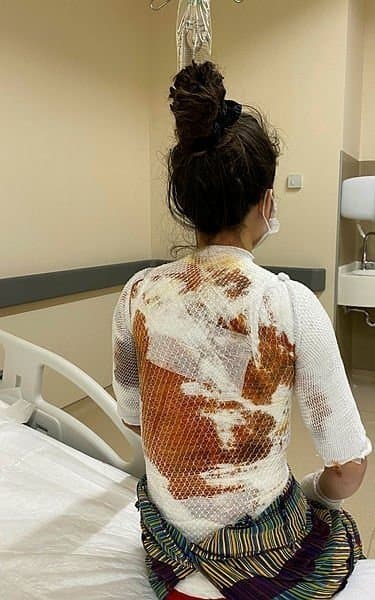 阿里不滿被盧琪亞打斷睡眠，竟拿滾燙開水朝她的頸部倒下，導致盧琪亞背部脫一層皮。  （翻攝Twitter）