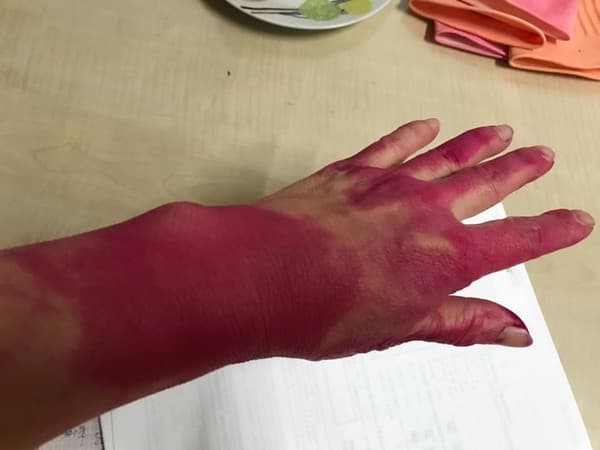 被染色的部位怎麼洗都洗不乾淨，網友趕緊帶家人就醫。（翻攝自爆廢公社臉書）