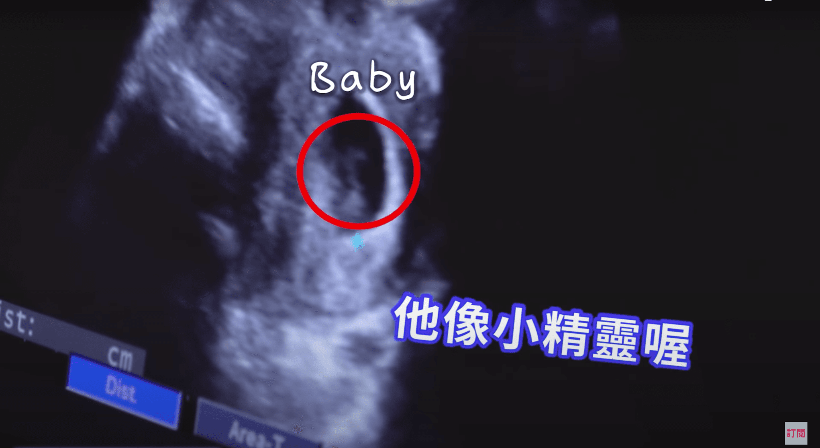 老公劉亮佐也難掩興奮，看著超音波中的寶寶影像直呼：「他（Baby）像小精靈喔！」（翻攝自《趙小僑女人說》Youtube） 