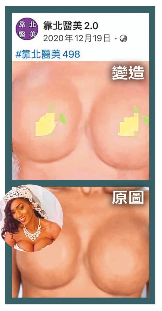 靠北醫美2.0曾貼出隆乳手術失敗照（上圖）指控A醫師，結果經過比對，該照片原圖竟是國外一則新聞照片（下圖），遭刻意刷白移花接木。（翻攝自靠北醫美2.0臉書）