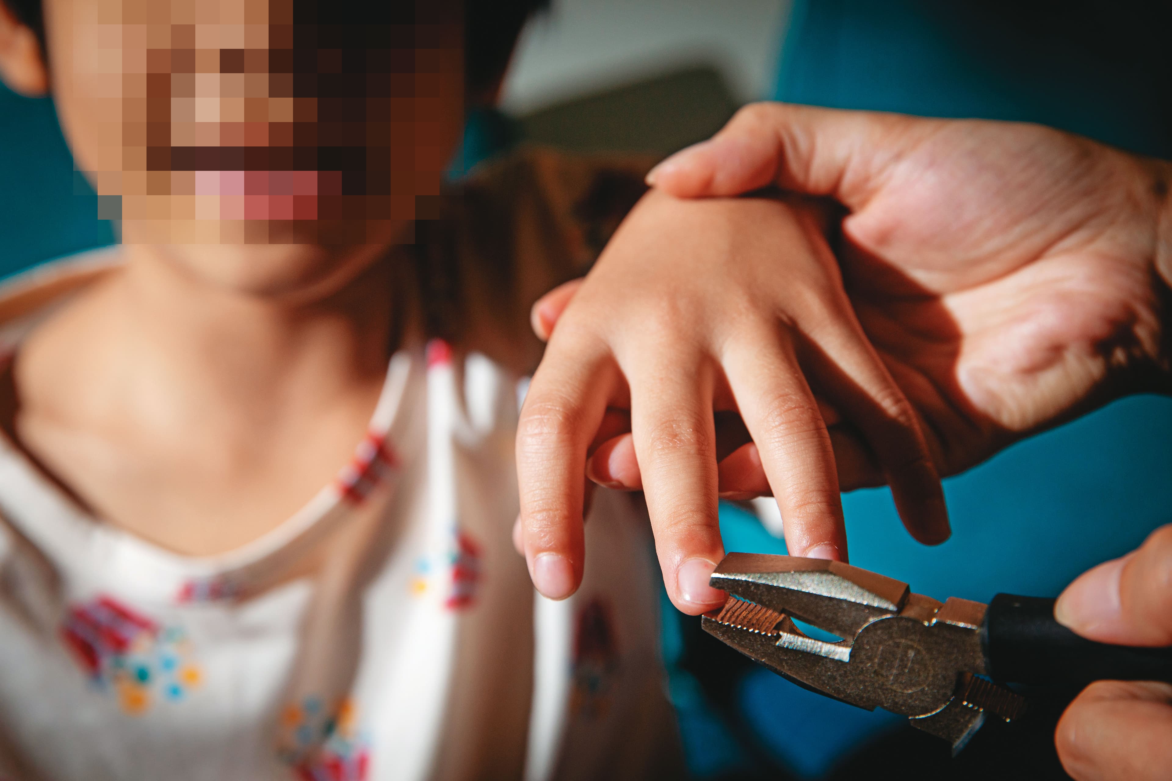 5歲男童遭外婆不定期拔除指甲，手指滿是血跡及結痂。（示意圖，非當事人）