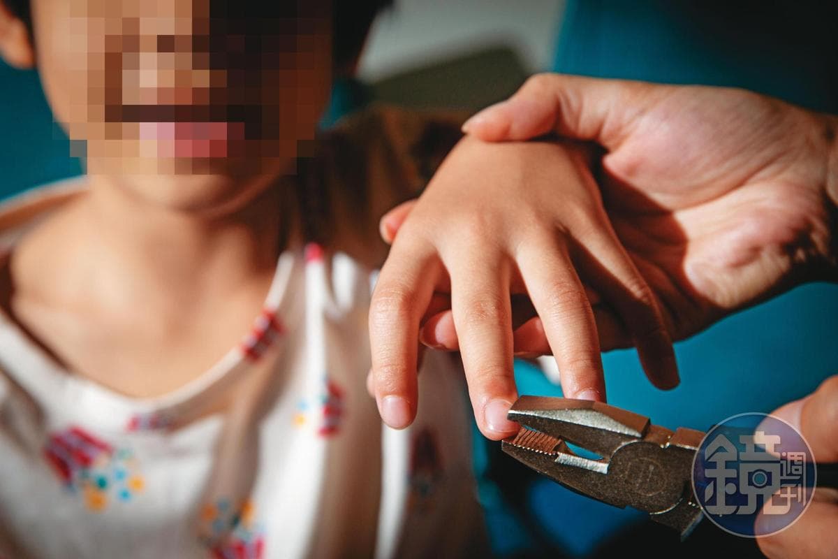 男童遭到外婆拔除指甲凌虐，手指滿是血跡及結痂。（示意圖）
