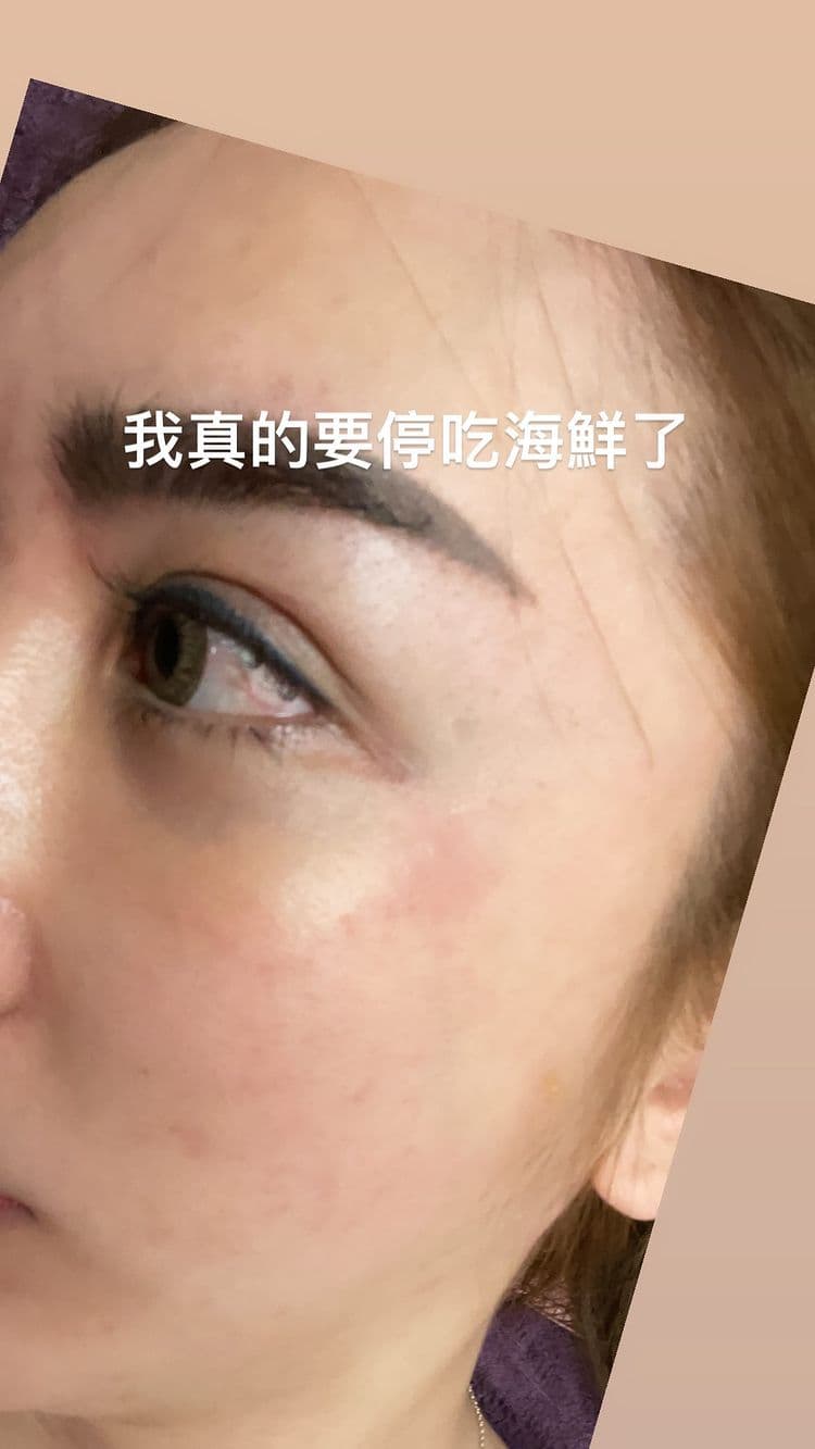 由於罔腰最近愛吃蝦子，疑似因此造成過敏，讓她覺得該忌口一下了。（翻攝自罔腰IG）