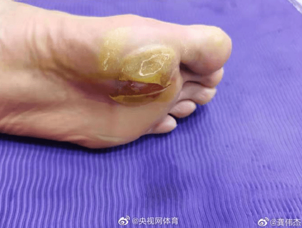 諶龍腳底起了個大水泡，傷口還破掉見肉了。（翻攝微博）