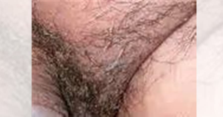 陰蝨常寄生於陰部，並邊吸血邊排糞，且幼蟲和蟲卵還會發生在毛囊的根部。（示意圖，翻攝自baidu.hk）