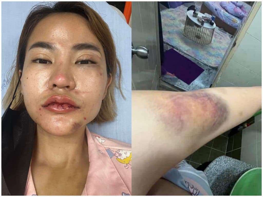 娃娃慘遭男友家爆。（翻攝自娃娃臉書）