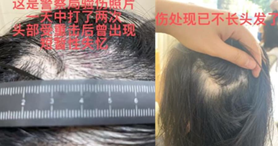 王東的老婆Annepple透露從警局回家後，王東對她進行更嚴重的毆打，把她打暈在地、昏迷不醒。（翻攝Annepple微博）