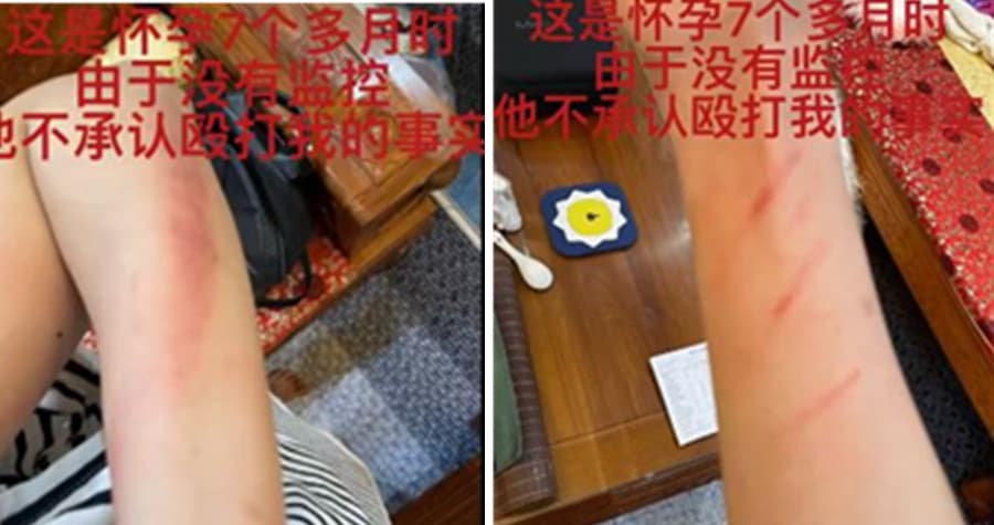 王東老婆公開自己懷孕7個月時被打的照片。（翻攝Annepple微博）