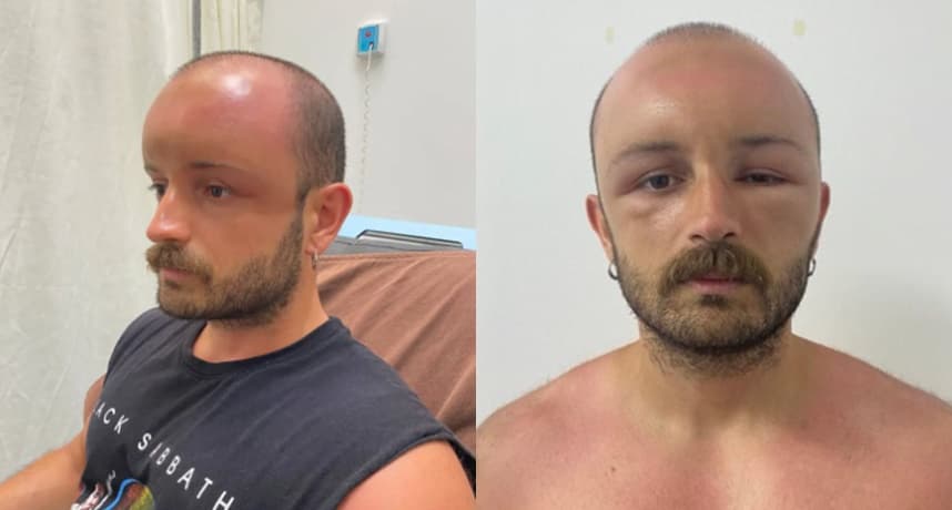 經檢查發現，男子面部腫脹是「熱水腫」引起，研判可能是因為戴了阻礙血液循環的帽子導致。（圖片翻攝自ladbible）