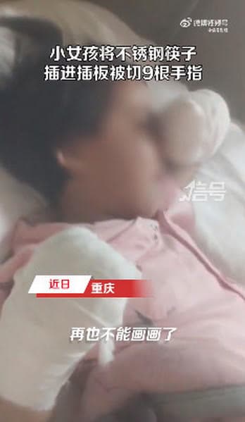 小女孩切除9根手指後，雙手裹上紗布，難過舉手拭淚。（翻攝微博@觀察者網）