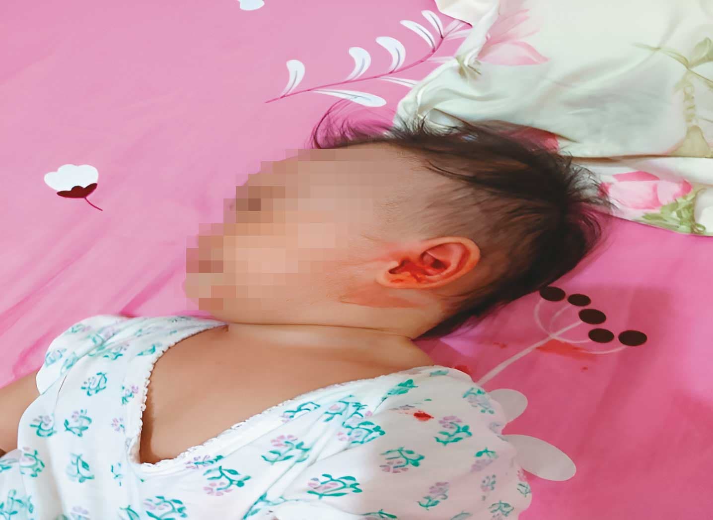 陳家1歲孫女被鄰居改建吵到噪動，抓傷自己的臉及耳朵致流血。（讀者提供）