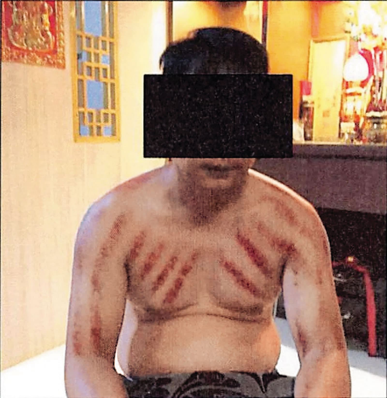美方在起訴書指控陳志以各種暴力手段凌虐被害人，遭圈禁的「豬仔」傷痕累累。（翻攝《紐約郵報》）