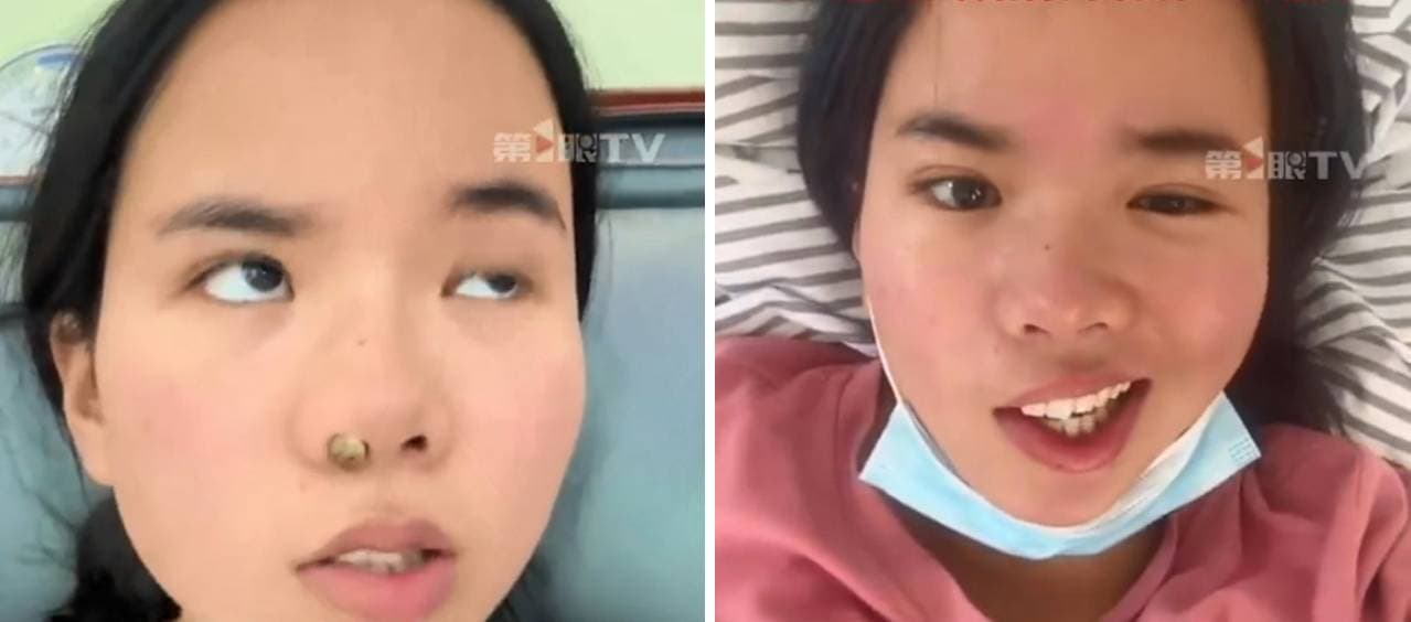 史女被診斷是「面癱」，嘴角經常無法控制，導致喝水、吃飯時經常漏出，讓她相當崩潰。（翻攝／微博）