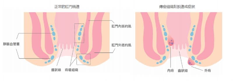 面對痔瘡問題，醫師提醒民眾無需過度羞恥或恐慌。（翻攝自衛福部網頁）