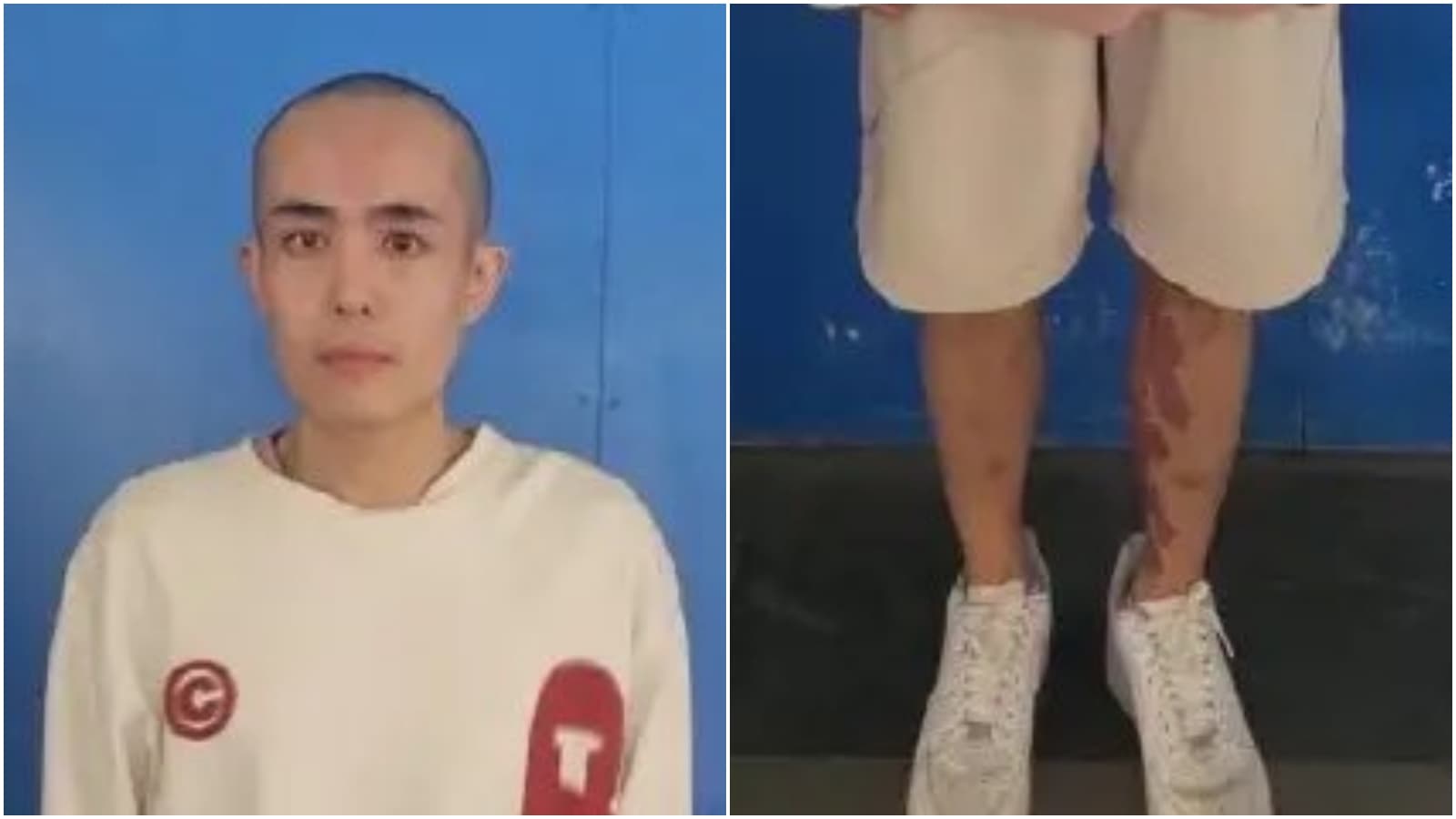 中國男演員星星已變大光頭，腿部疑有傷勢。（翻攝X）