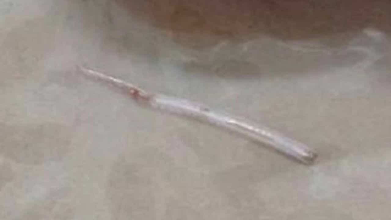 長達近2公分的魚刺卡喉2週，最終從頸部皮膚冒出，被醫師手術取出。（翻攝自thethaiger）
