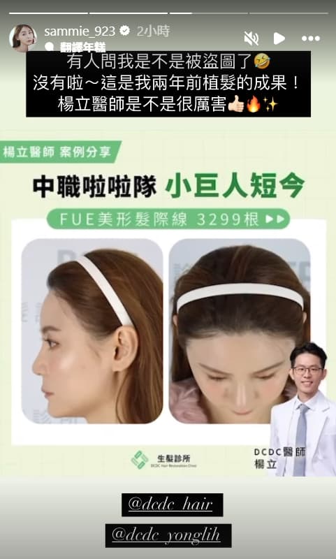 短今在IG限時動態PO出她植髮後的照片，澄清該廣告沒有盜圖。（翻攝自IG sammie_923）