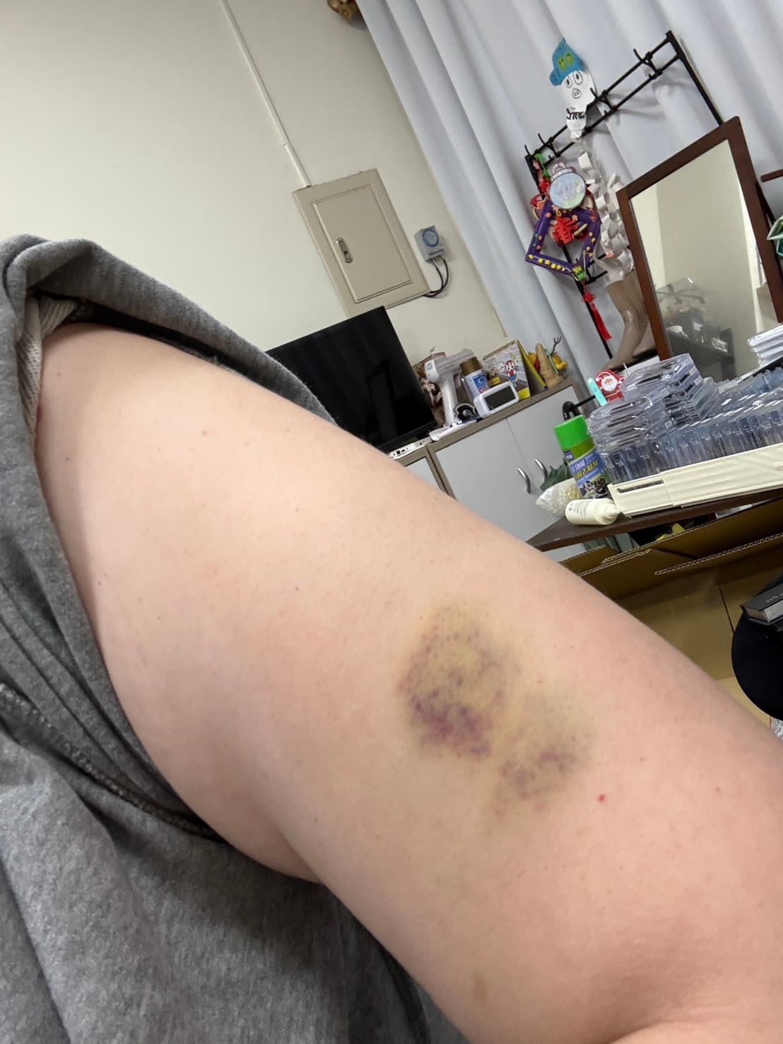 Ｗ女被打全身傷痕累累。（讀者提供）