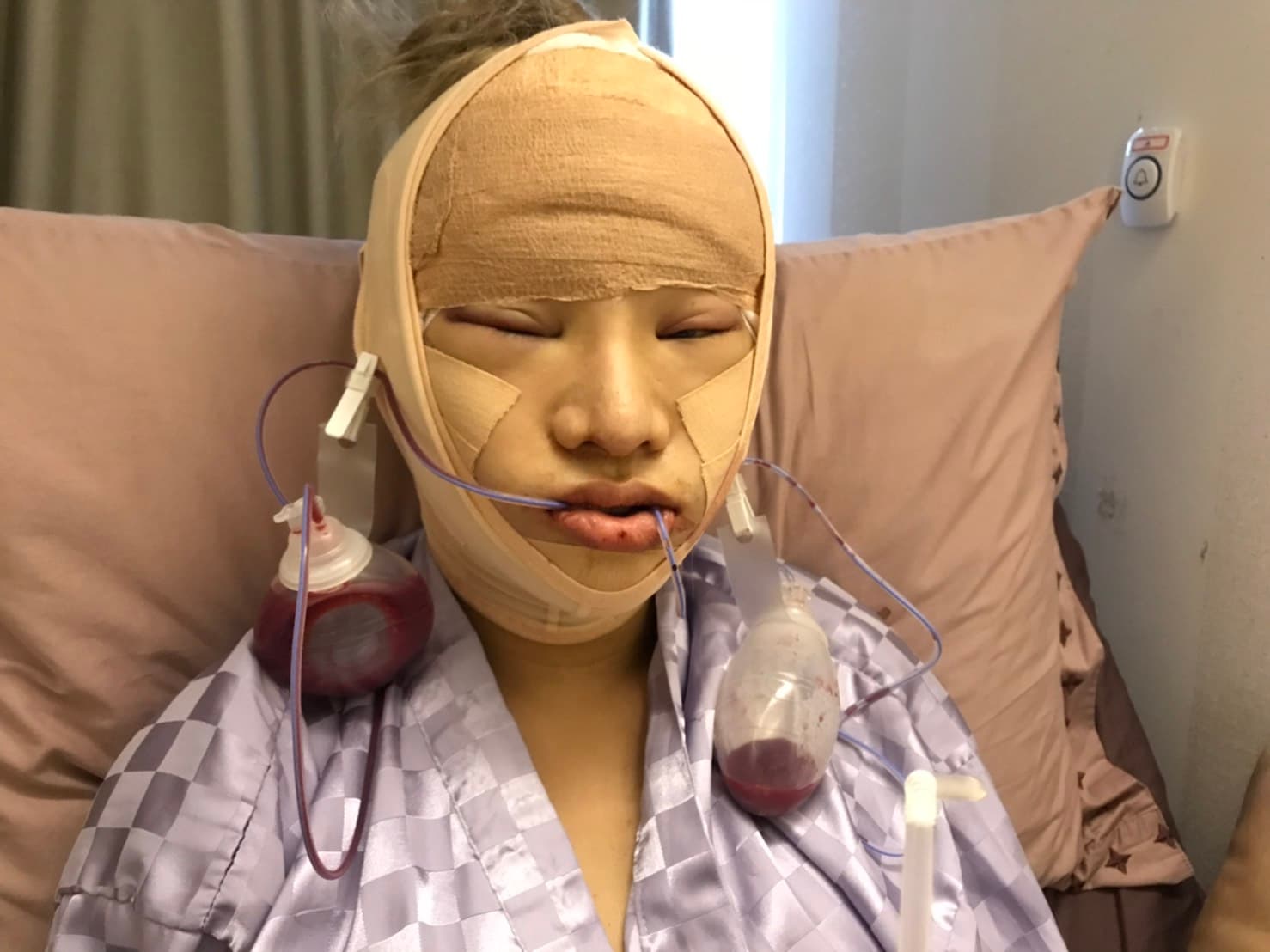 小A辣經歷多次整形手術，至今都還想再繼續優化外型。（小A辣提供）