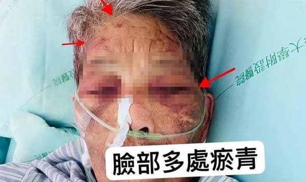 阿嬤臉上青一片、紫一片，到處都是瘀青。（翻攝畫面）