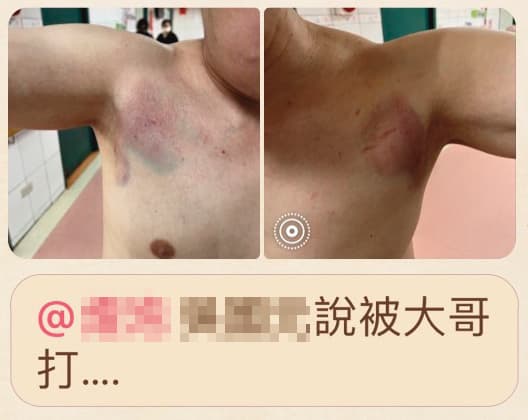 吳姓男子（圖）也遭痛毆，全身滿是傷痕。（投訴人提供）