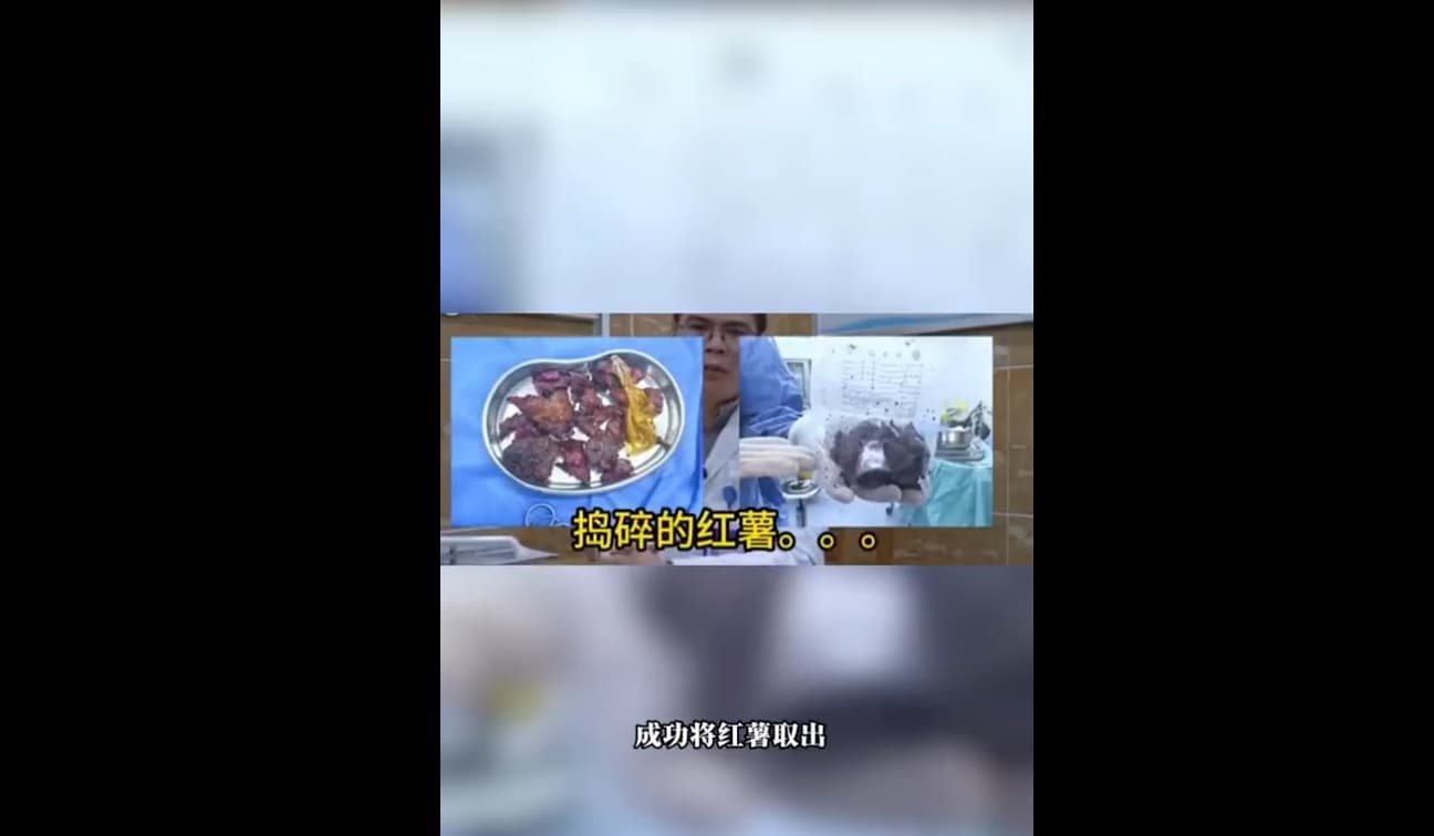 醫師最終以開腹方式取出男子體內的地瓜。（翻攝自微博）
