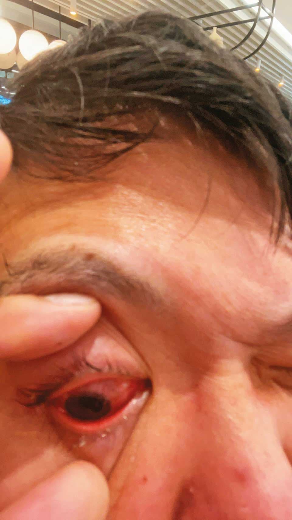 被警方壓制過程中，黃先生的眼角膜破裂受傷。（讀者提供）
