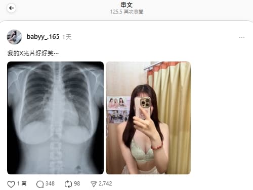 網紅「兔兔」分享X光片照，意外爆紅。（翻攝自Threads）