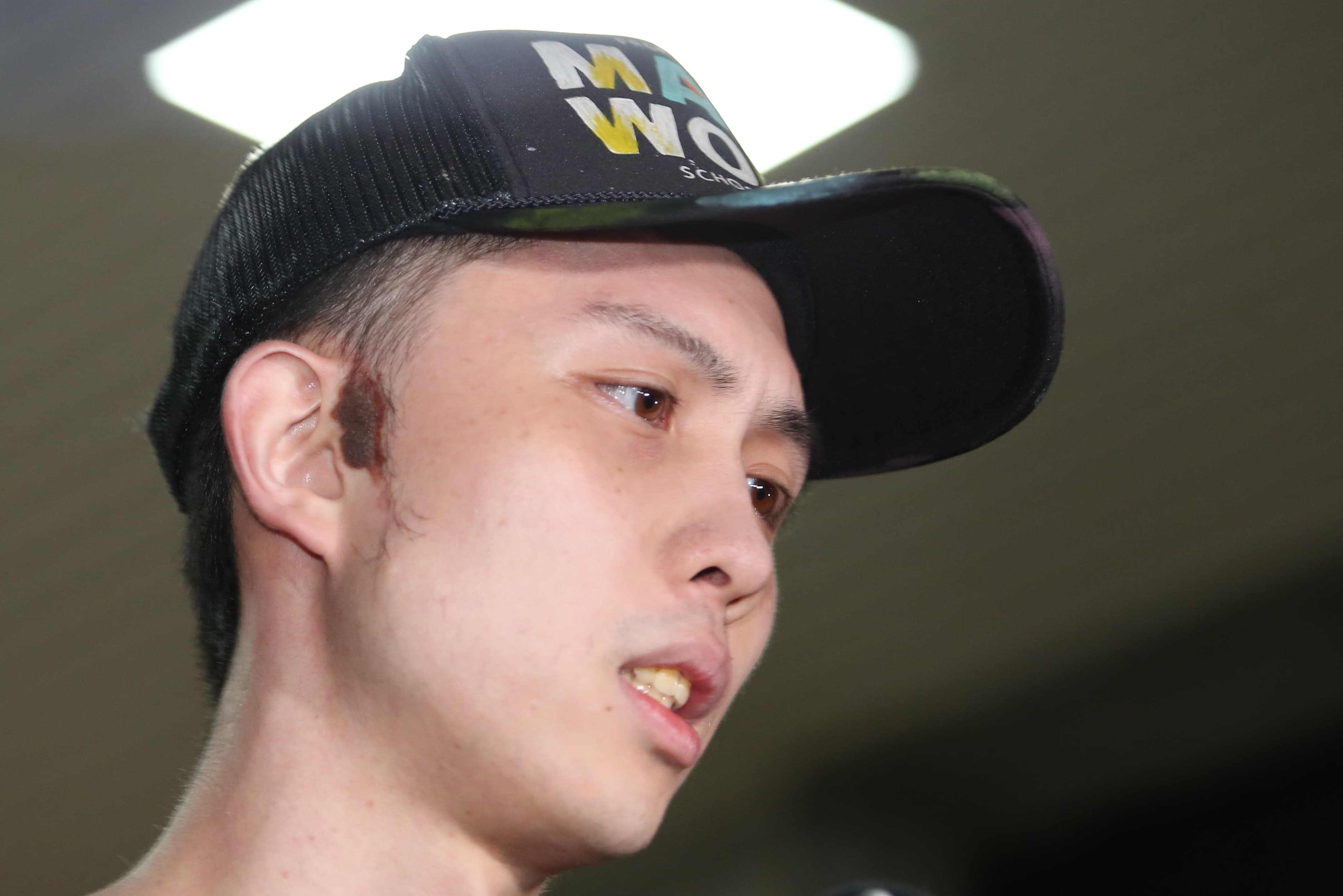 孫安佐右臉胎記一度被認為是傷痕，實際是胎記。（鏡報姜永年攝）